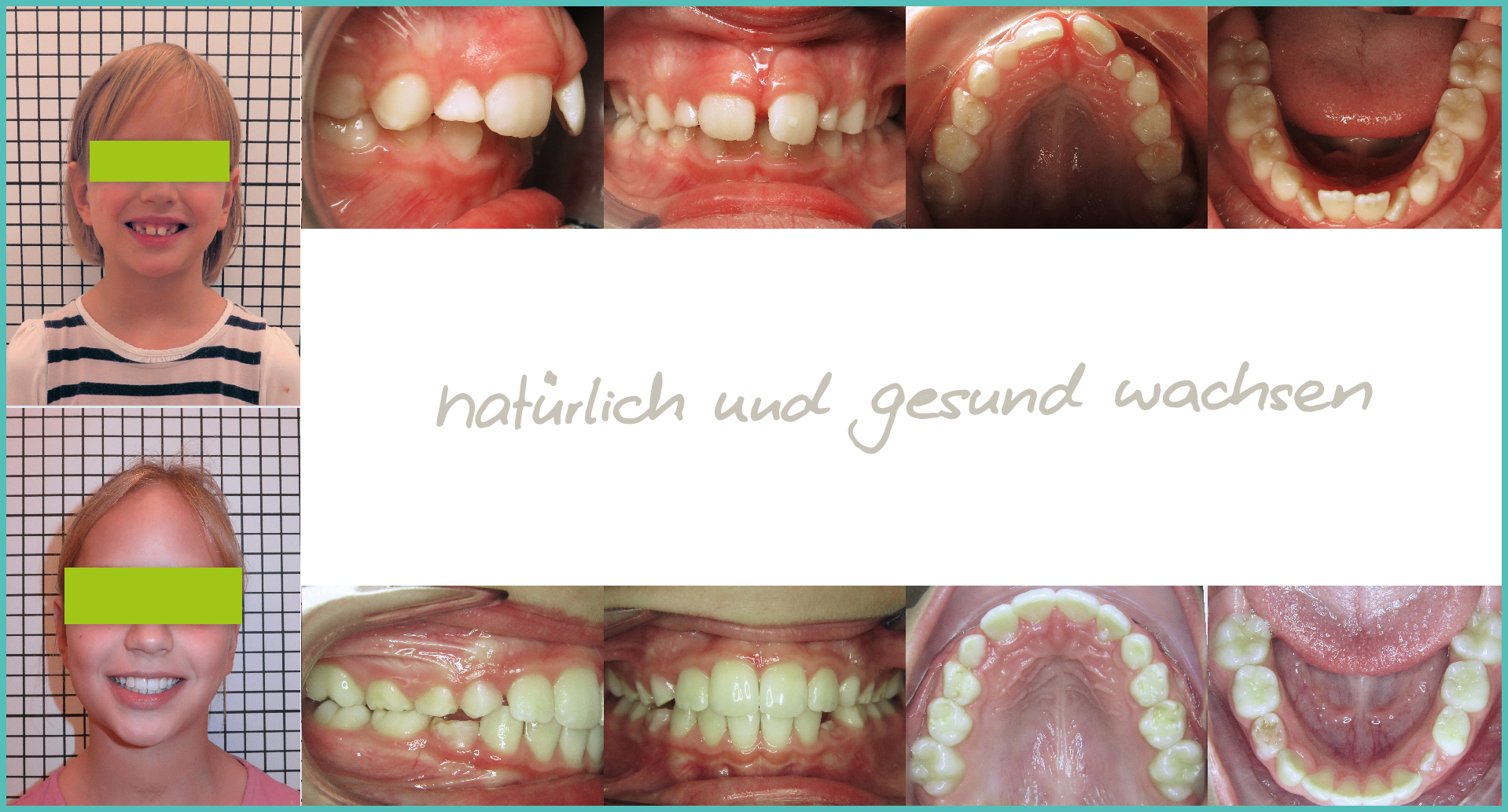 Fallbeispiel Zahnengstand, Rücklage des Unterkiefers und Zahnfleischlächeln in der kieferorthopädischen Frühbehandlung bei Dr. Andrea Freudenberg in Weinheim