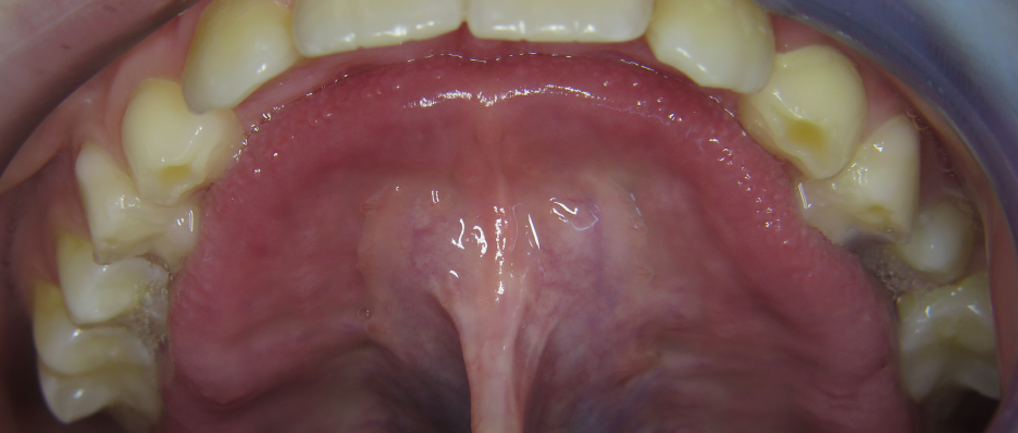 Die Zunge sieht aus wie ein Pilz. mykie® kieferorthopädischen Frühbehandlung bei Dr. Andrea Freudenberg in Weinheim Die Zunge sieht aus wie ein Pilz. mykie® kieferorthopädischen Frühbehandlung bei Dr. Andrea Freudenberg in Weinheim