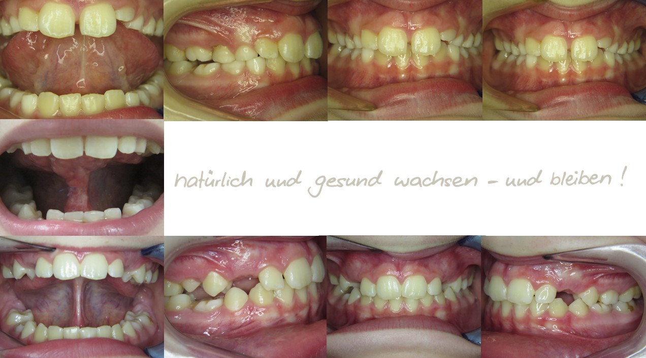 Fallbeispiel, 8,9 Jahre alt, mykie®Therapie + Frenuloplastik in der mykie® kieferorthopädischen Frühbehandlung bei Dr. Andrea Freudenberg in Weinheim Fallbeispiel, 8,9 Jahre alt, mykie®Therapie + Frenuloplastik in der mykie® kieferorthopädischen Frühbehandlung bei Dr. Andrea Freudenberg in Weinheim