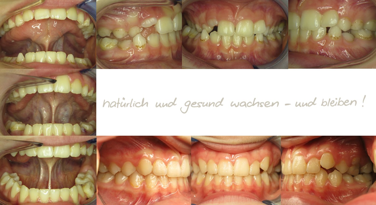 Fallbeispiel, 7,5 Jahre alt, mykie® Therapie mit Zungenbanddehnung in der mykie® kieferorthopädischen Frühbehandlung bei Dr. Andrea Freudenberg in Weinheim
