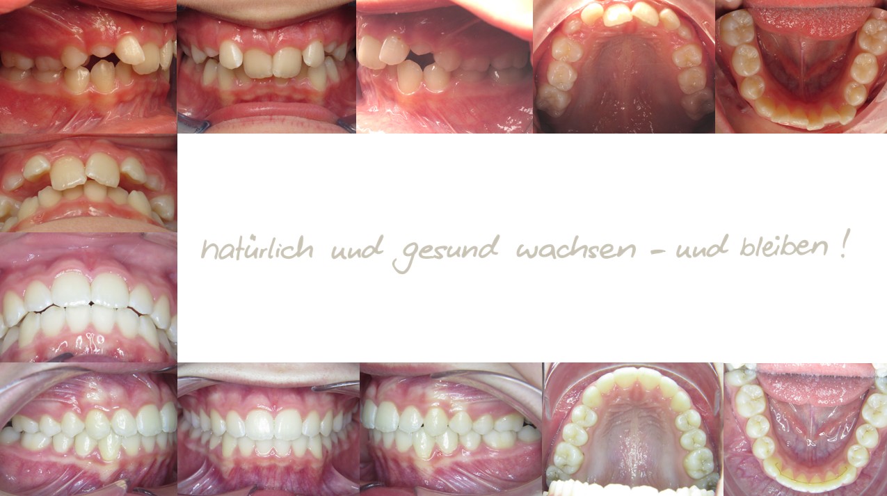 Fallbeispiel eines 10-jährigen Jugendlichen mit Einlagerung der Unterlippe in der mykie® kieferorthopädischen Frühbehandlung bei Dr. Andrea Freudenberg in Weinheim