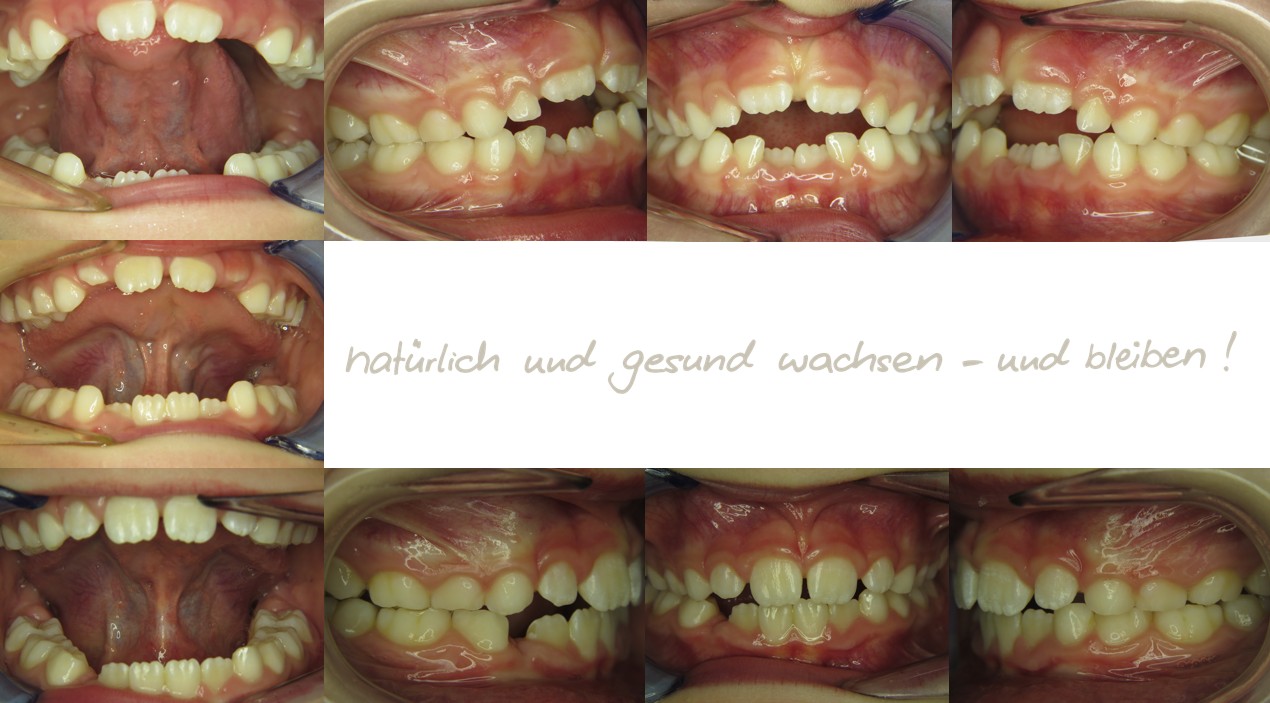 Fallbeispiel, 7,6 Jahre alt, mykie® Therapie + Frenuloplastik in der mykie® kieferorthopädischen Frühbehandlung bei Dr. Andrea Freudenberg in Weinheim