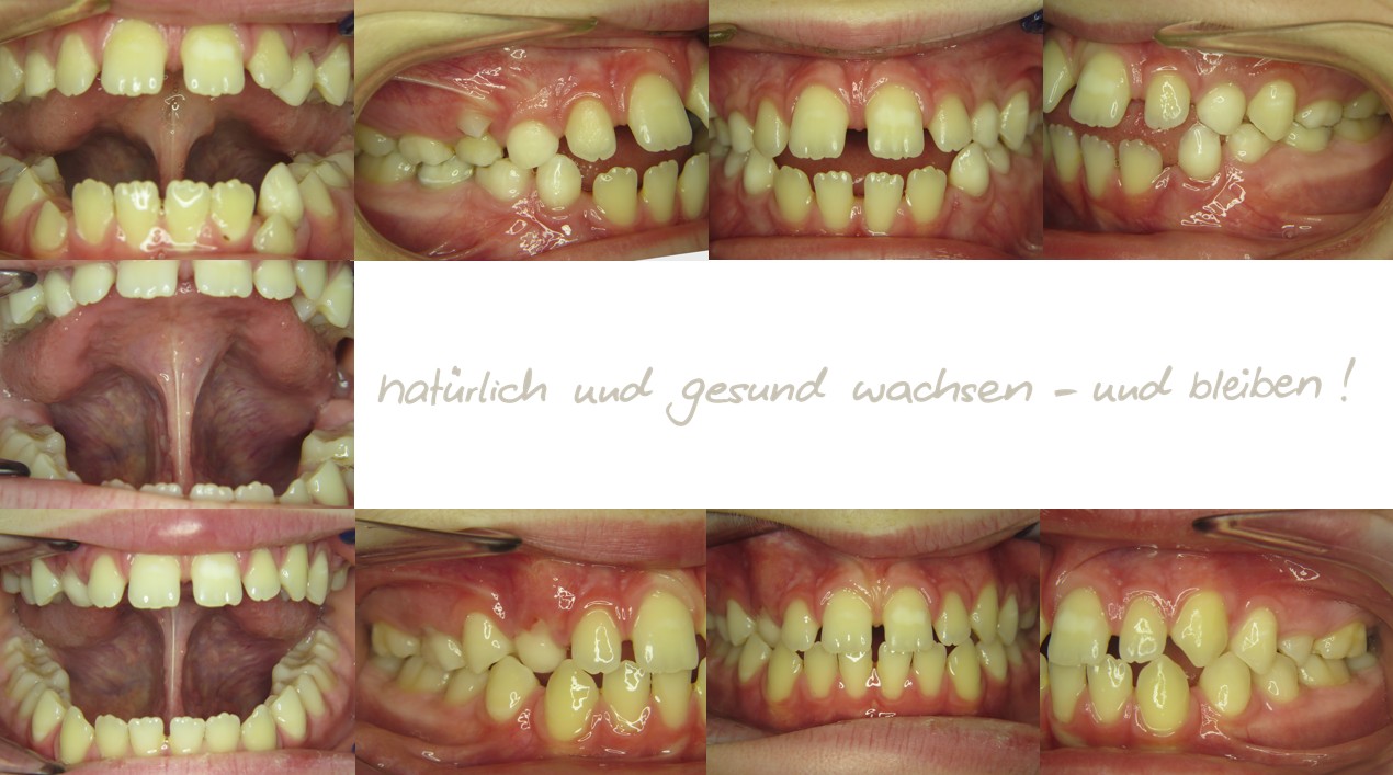 Fallbeispiel, 9,1 Jahre alt, mykie® Therapie mit Zungenbanddehnung in der mykie® kieferorthopädischen Frühbehandlung bei Dr. Andrea Freudenberg in Weinheim