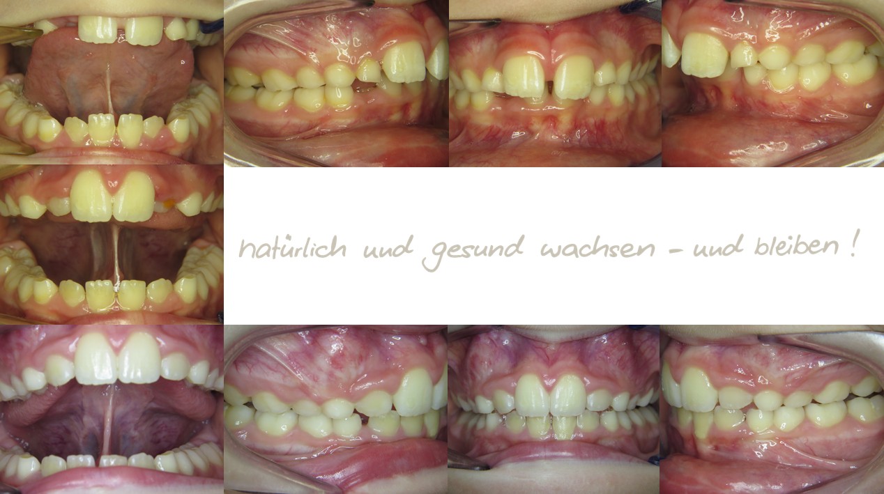 Fallbeispiel, 8,5 Jahre alt, mykie® Therapie + Frenuloplastik in der mykie® kieferorthopädischen Frühbehandlung bei Dr. Andrea Freudenberg in Weinheim