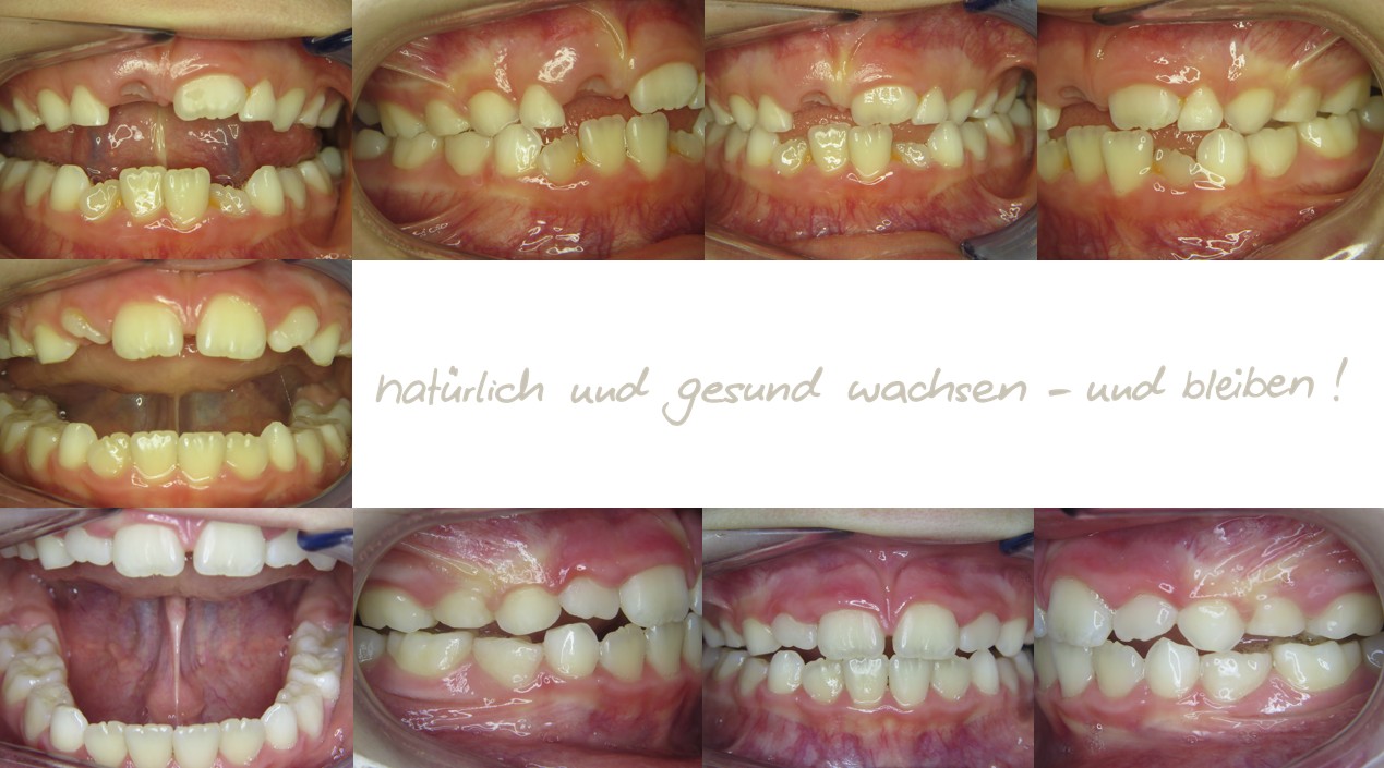Fallbeispiel, 8,3 Jahre alt, mykie® Therapie mit Zungenbanddehnung in der mykie® kieferorthopädischen Frühbehandlung bei Dr. Andrea Freudenberg in Weinheim