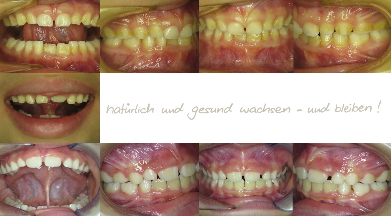 Fallbeispiel, 8,3 Jahre alt, mykie® Therapie + Frenuloplastik in der mykie® kieferorthopädischen Frühbehandlung bei Dr. Andrea Freudenberg in Weinheim Fallbeispiel, 8,3 Jahre alt, mykie® Therapie + Frenuloplastik in der mykie® kieferorthopädischen Frühbehandlung bei Dr. Andrea Freudenberg in Weinheim