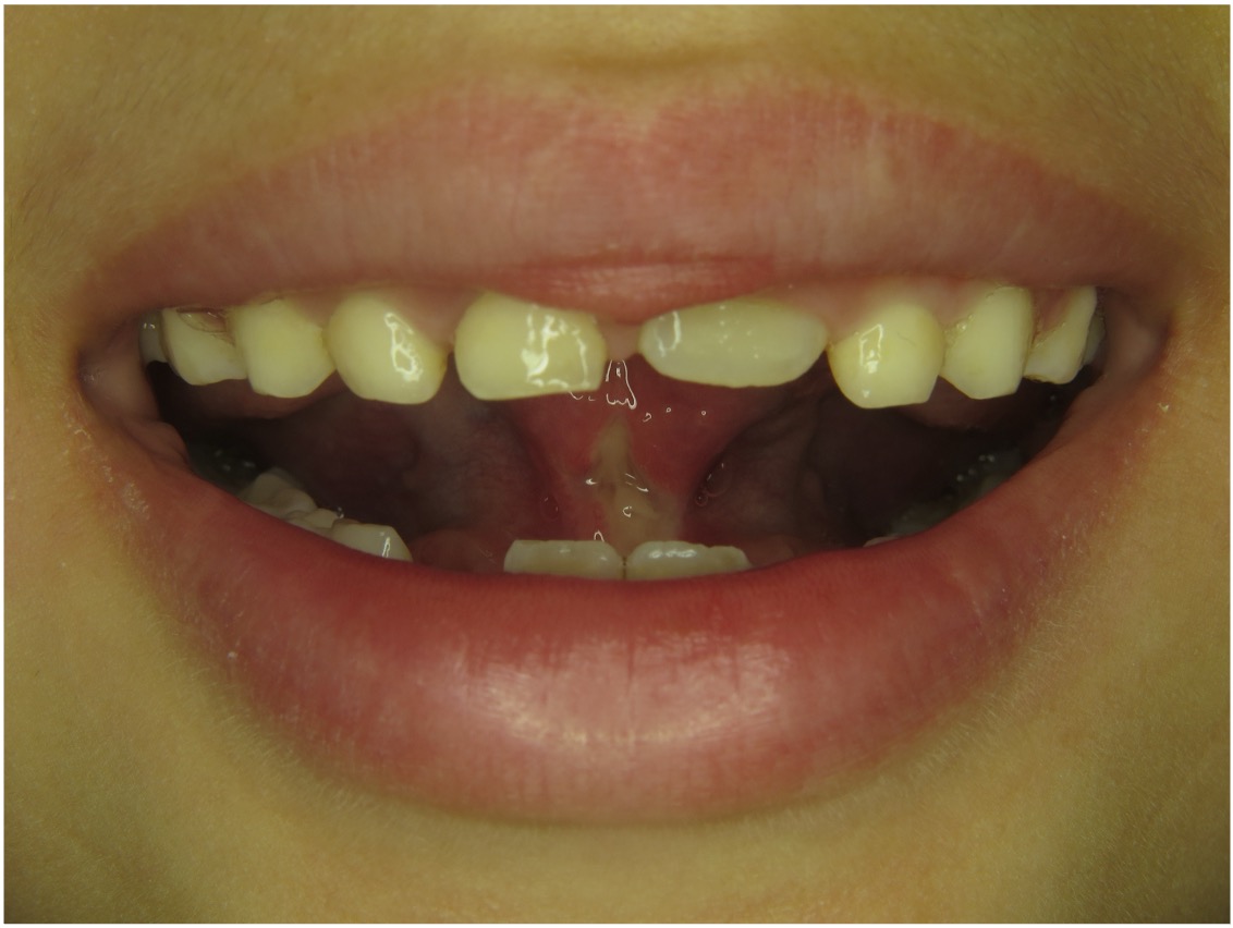 Fallbeispiel, 8,3 Jahre alt, mykie® Therapie + Frenuloplastik in der mykie® kieferorthopädischen Frühbehandlung bei Dr. Andrea Freudenberg in Weinheim