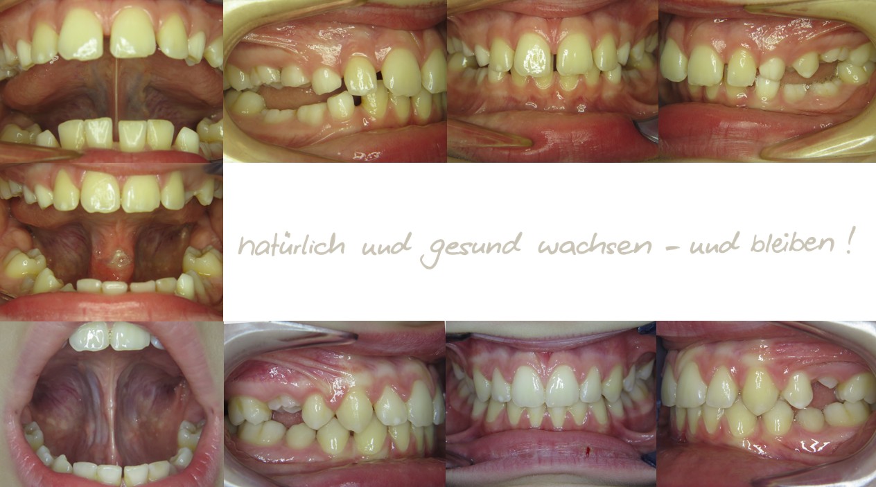 Fallbeispiel, 9,5 Jahre alt, mykie® Therapie + Frenuloplastik in der mykie® kieferorthopädischen Frühbehandlung bei Dr. Andrea Freudenberg in Weinheim