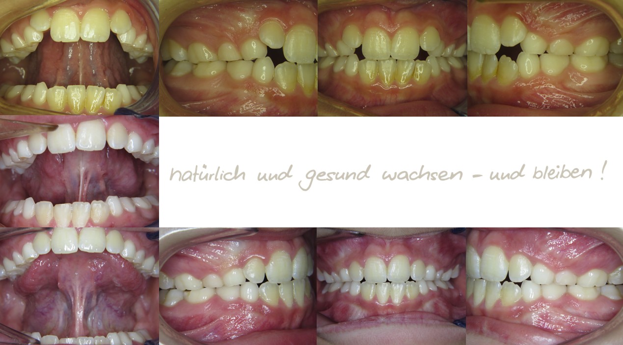 Fallbeispiel, 9,9 Jahre alt, mykie® Therapie + Frenuloplastik in der mykie® kieferorthopädischen Frühbehandlung bei Dr. Andrea Freudenberg in Weinheim