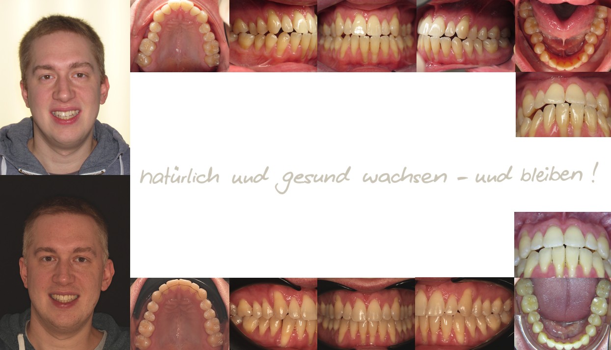 Fallbeispiel eines 33-jährigen Erwachsenen mit kurzem Zungenband und tiefer Zungenlage in der mykie® kieferorthopädischen Frühbehandlung bei Dr. Andrea Freudenberg in Weinheim Fallbeispiel eines 33-jährigen Erwachsenen mit kurzem Zungenband und tiefer Zungenlage in der mykie® kieferorthopädischen Frühbehandlung bei Dr. Andrea Freudenberg in Weinheim