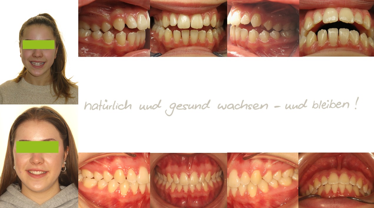 Fallbeispiel einer 15-jährigen Jugendlichen mit offenem Biss und Kreuzbiss in der mykie® kieferorthopädischen Frühbehandlung bei Dr. Andrea Freudenberg in Weinheim