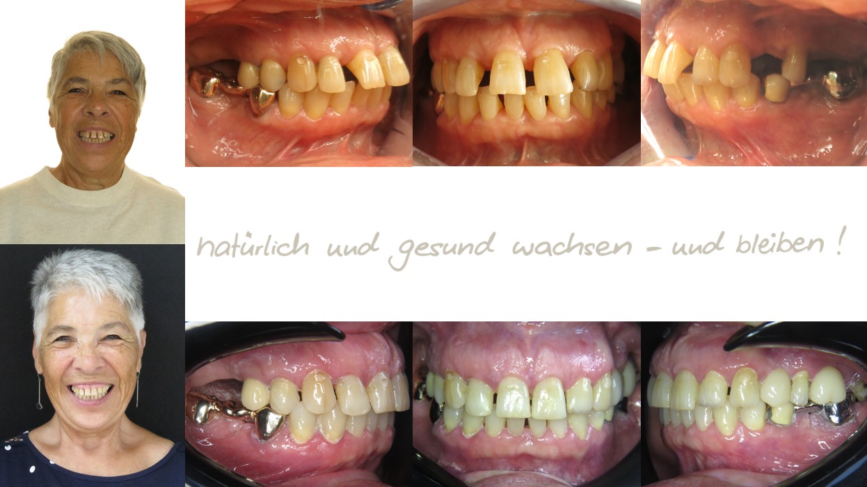 Fallbeispiel einer 65-jährigen Erwachsenen mit frontaler Zungenlage in der mykie® kieferorthopädischen Frühbehandlung bei Dr. Andrea Freudenberg in Weinheim