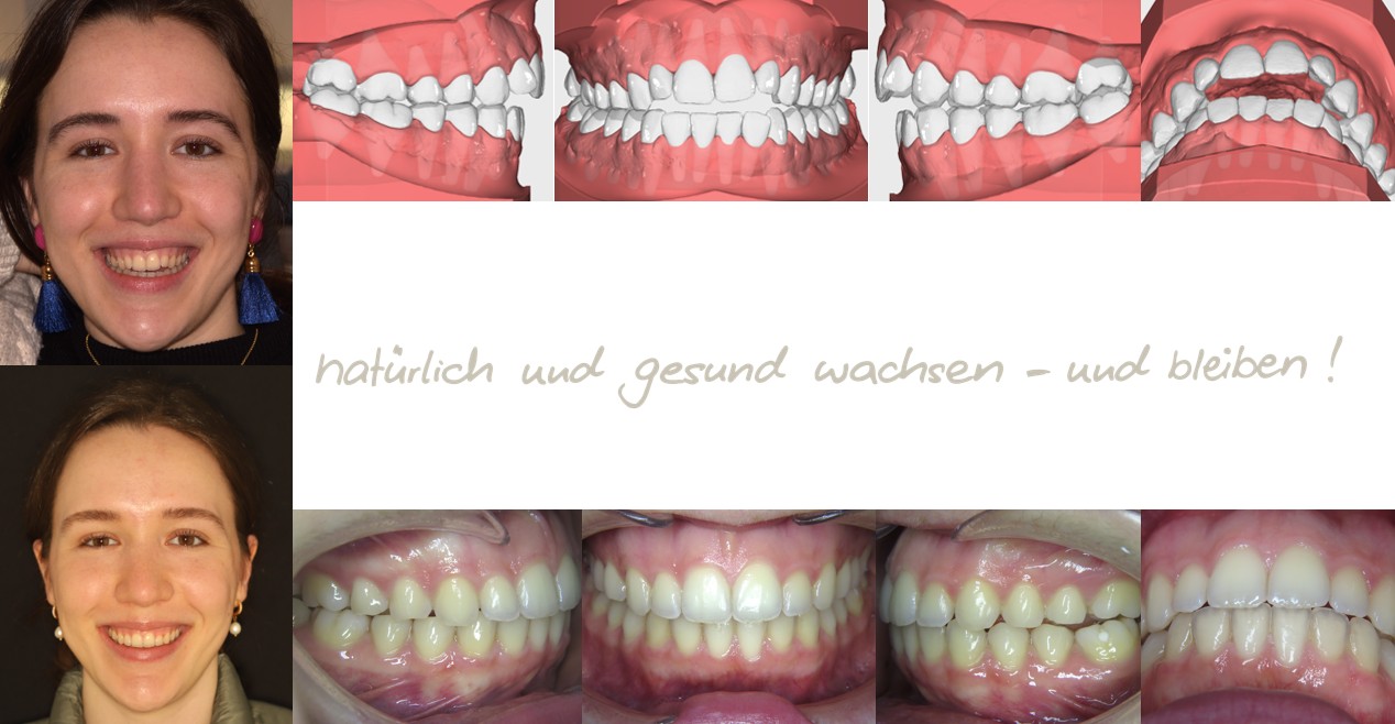 Fallbeispiel einer 25-jährigen Erwachsenen mit offenem Biss in der mykie® kieferorthopädischen Frühbehandlung bei Dr. Andrea Freudenberg in Weinheim Fallbeispiel einer 25-jährigen Erwachsenen mit offenem Biss in der mykie® kieferorthopädischen Frühbehandlung bei Dr. Andrea Freudenberg in Weinheim